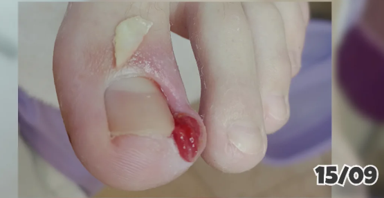 Antes del tratamiento de Onicocriptosis (uña encarnada)